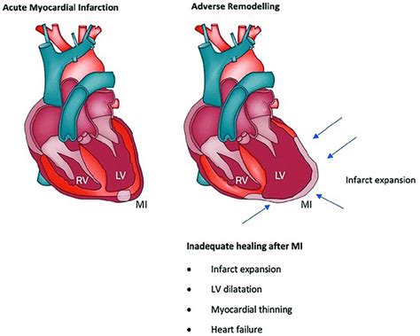 aging decreases post-infarction lv dilation|Left Ventricular Post.